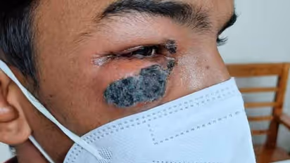 മദ്ധ്യപ്രദേശില് നാല് ബ്ലാക്ക് ഫംഗസ് മരണം; ശ്രദ്ധിച്ചില്ലെങ്കില് ജീവനെടുക്കുന്ന വില്ലനായി ബ്ലാക്ക് ഫംഗസ്