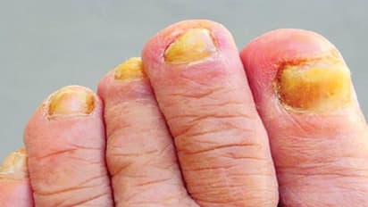 ఎల్లో ఫంగస్ : మరో మహమ్మారి.. బ్లాక్, వైట్ ఫంగస్ ల కంటే డేంజర్... !