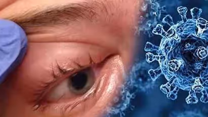 ರಾಜ್ಯದಲ್ಲಿ ಈವರೆಗೆ ಎಷ್ಟು ಬ್ಲ್ಯಾಕ್ ಫಂಗಸ್ ಕೇಸ್? ಎಷ್ಟುಸಾವು? ಗುಣಮುಖವೆಷ್ಟು?