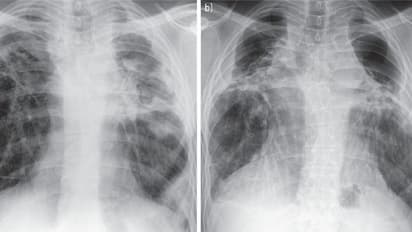 ఒకే వ్యక్తిలో బ్లాక్, వైట్, యెల్లో ఫంగస్... రక్తం మొత్తం విషపూరితం, చికిత్స పొందుతూ మృతి