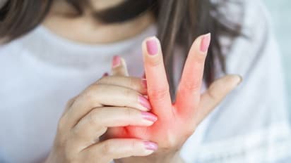Skin care: Treat and cure eczema with these simple home remedies