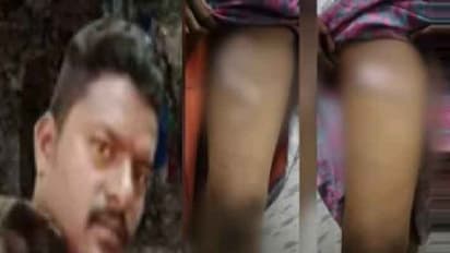 மயக்க மருந்து கொடுத்து கணவர் செய்த காரியம்... அந்தரங்க பகுதி, மார்பு உட்பட 16 இடங்களில் சூடு வைத்த கொடூரம்..!