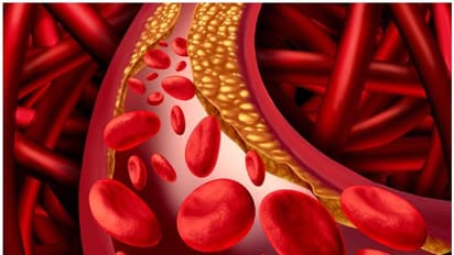 ചീത്ത കൊളസ്ട്രോൾ കുറയ്ക്കാൻ ഇവ ശ്രദ്ധിക്കാം