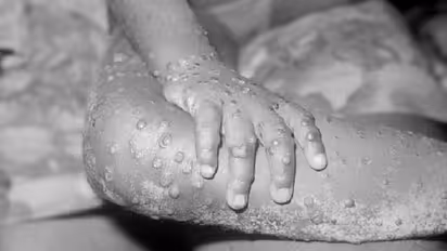 Monkeypox :  12 രാജ്യങ്ങളിലായി 80 പേർക്ക് കുരങ്ങുപനി സ്ഥിരീകരിച്ചെന്ന് ലോകാരോഗ്യ സംഘടന