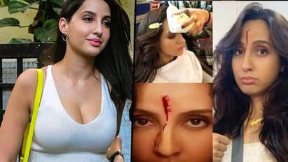 Nora Fatehi gets permanent scar on face; actress bleeds from her head; check picture