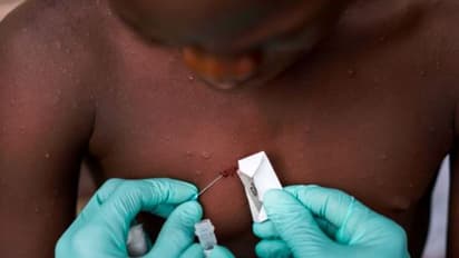 Monkey Pox is 'accelerating' fast, warn WHO officials: 10 points