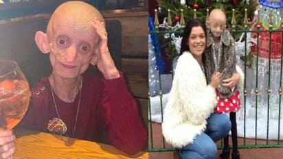 ജനിച്ചുവീഴുമ്പോഴേ വാര്ധക്യവുമായി വന്ന പെൺകുട്ടി, 18 വയസ് വരെ പൊരുതി, ഒടുവിലവൾ യാത്രയായി