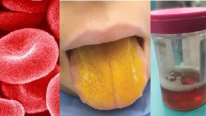 നാവിന് മഞ്ഞ നിറം, മൂത്രം ചുവന്ന നിറം; രോഗപ്രതിരോധ ശേഷിയെ അപൂര്വ്വ രോഗവുമായി പന്ത്രണ്ടുകാരന്