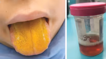 ಕೊರೋನಾ ಮಧ್ಯೆ ಹೊಸ ರೋಗ, ನಾಲಗೆ ಬಣ್ಣ ಹಳದಿ!