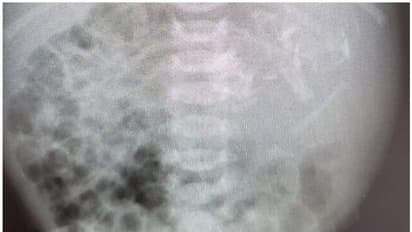 നവജാത ശിശുവിന്റെ വയറിനുള്ളിൽ ഭ്രൂണം; അപൂർവ്വ സംഭവമെന്ന് ഡോക്ടർമാർ