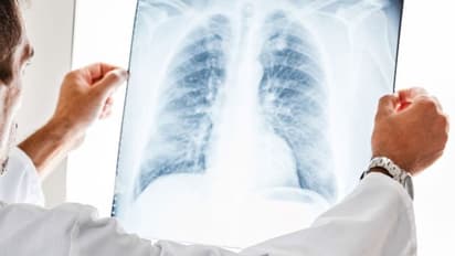 ആസ്ത്മയെന്ന് കരുതി ദീര്ഘകാല ചികിത്സ; 18 വർഷത്തിനു ശേഷം പുറത്തെടുത്ത് പേനയുടെ അഗ്രം!