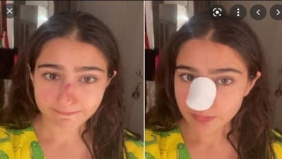 సారా అలీ ఖాన్ ముక్కు పగిలింది.. కొట్టిందెవరు?