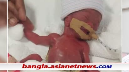 জন্মের সময় ওজন ছিল একটা আপেলের মতো, ১৩ মাস পর বাড়ি গেল বিশ্বের ক্ষুদ্রতম শিশু
