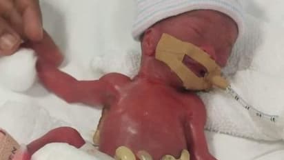 सेब के बराबर वजन का बच्चा, जिसे देख डॉक्टर भी हुए थे हैरान, अब उसी की क्यों कर रहे जमकर तारीफ