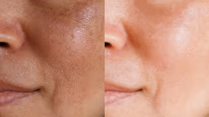 മുഖത്തെ കുഴികൾ മാറാന്‍ പരീക്ഷിക്കാം ഈ ആറ് വഴികള്‍...