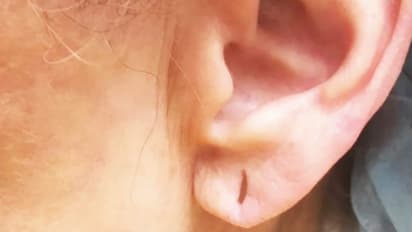 കാതിലെ കമ്മൽദ്വാരത്തിലൂടെ കാമുകന്റെ പരാക്രമം; ദുരവസ്ഥ വിവരിച്ച് യുവതി