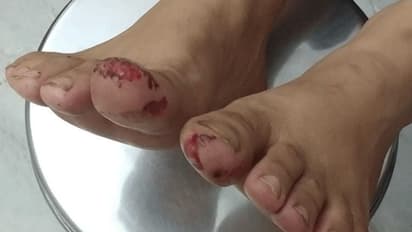 ಶಿವಮೊಗ್ಗ: ಅಡಕೆ ಬೇಯಿಸುವ ಹಂಡೆಗೆ ಬಿದ್ದಿದ್ದ ಮಗು ಸಾವು