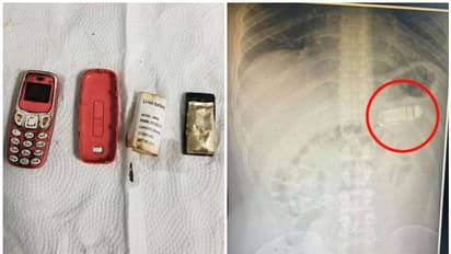 33കാരൻ നോക്കിയ 3310 ഫോൺ വിഴുങ്ങി; ശസ്ത്രക്രിയയിലൂടെ ഫോൺ പുറത്തെടുത്തു