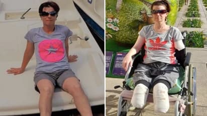 पेट में दर्द होने पर डॉक्टर के पास गई महिला, फिर ऐसा क्या हुआ कि 11 दिन में दोनों पैर-एक हाथ काटना पड़ा