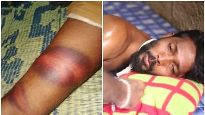 ബൈക്ക് നിര്ത്തി മൂത്രം ഒഴിക്കാൻ ഇറങ്ങിയ രോഗിയായ യുവാവിന് പൊലീസ് ക്രൂരമായി മര്ദ്ദിച്ചതായി ആരോപണം