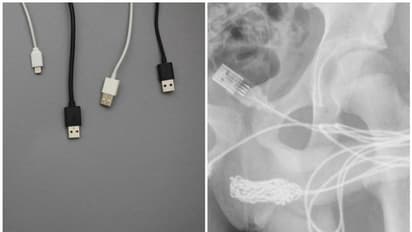 ലിംഗത്തിൽ യുഎസ്ബി കേബിൾ കുടുങ്ങി കൗമാരക്കാരൻ; അത്യഹിതം സംഭവിച്ചത് 'നീളമെടുക്കാനുള്ള' സാഹസത്തിൽ.!