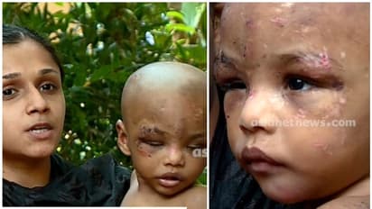 ദേഹമാസകലം ചോര വാർന്നൊലിക്കുന്ന മുറിവുകളുമായി ഒന്നരവയസ്സുകാരൻ; ചികിത്സാ ചെലവിന് വലഞ്ഞ് നിർധന കുടുംബം