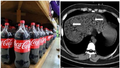ഒന്നരലിറ്റർ കൊക്കക്കോള പത്തുമിനിട്ടിൽ കുടിച്ചിറക്കിയ ഇരുപത്തിരണ്ടുകാരന് ദാരുണാന്ത്യം എന്ന് ഡോക്ടർമാർ