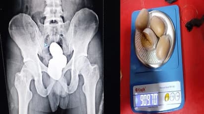 ఛీ..ఛీ.. ఆ ప్రదేశాన్నీ వదలలేదు.. మలద్వారంలో ఏడుకిలోల బంగారం స్మగ్లింగ్...