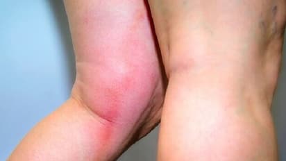 Blood Clot Symptoms : শরীরে রক্ত জমাট বেধেছে, ভয়ঙ্কর রোগে আক্রান্ত হওয়ার আগে সাবধান