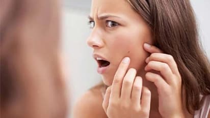 മുഖക്കുരുവിന്റെ കറുത്ത പാടുകള് അകറ്റാന് പരീക്ഷിക്കാം ഈ ഫേസ് പാക്കുകള്...