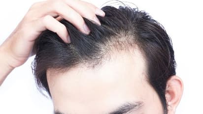 పురుషులకు ఇందుకే జుట్టు ఊడిపోతుంది..