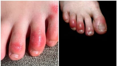 കാൽ വിരലുകളിൽ ചുവന്ന തിണർപ്പും ചൊറിച്ചിലും; എന്താണ് 'കൊവിഡ് ടോസ്'?