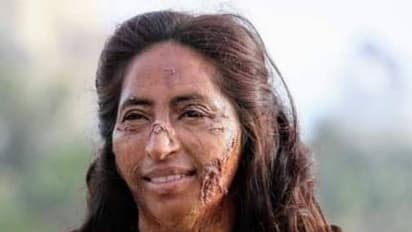 'ആസിഡ് വീണതും തൊലി ഉരുകി, കണ്ണും വായയും തുറക്കാനായില്ല,  എന്നെക്കണ്ട് ഞാന്‍തന്നെ ഭയന്നു'