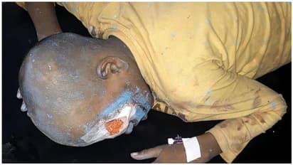 பட்டாசு வெடித்ததில் இடது கண்ணை இழந்த 11 வயது சிறுவன்... வேடிக்கை பார்த்தபோது நடந்த பரிதாபம்..!