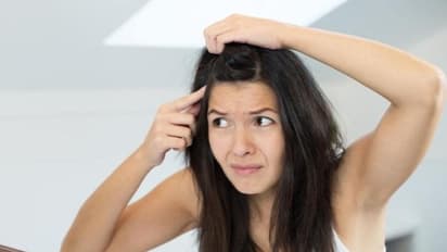 Hair Care| താരന്‍ അകറ്റാന്‍ പരീക്ഷിക്കാം ഈ അഞ്ച് മാര്‍ഗങ്ങള്‍...