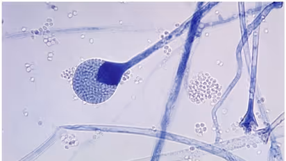 black fungus| ബ്ലാക്ക് ഫംഗസ് പ്രമേഹരോഗികളിൽ കൂടുതൽ:  പഠനം