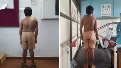 ജിത്തുവിന് നിവര്ന്നു നില്ക്കാന് താങ്ങായി സൗജന്യ നട്ടെല്ല് നിവര്ത്തല് ശസ്ത്രക്രിയ