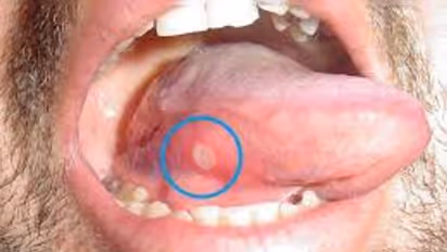 Mouth Ulcer: மழைக்காலங்களில் வரும் வாய்ப்புண்...? ஒரே நாளில் போக இயற்கை வீட்டு வைத்தியம்...