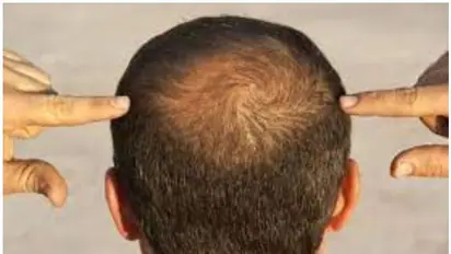 Baldness: చిన్న వయసులోనే బట్టతల వచ్చేసిందా? ఈ నూనెలను వాడండి.. జుట్టు ఊడటం ఆగిపోతుంది..