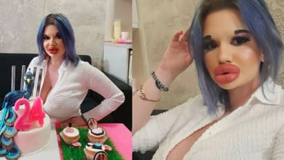 दुनिया में सबसे बड़े होंठ: डॉल की तरह दिखने के चक्कर में लाखों रु खर्च किए, होंठ इतना बड़ा हुआ कि फटने का डर