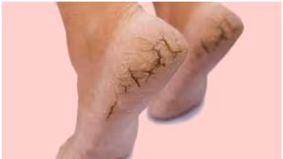 குளிர்காலம் துவங்கிவிட்டால் குதிகால் வெடிப்பு பிரச்னையும் பின்னாடியே வந்துவிடும்- என்ன செய்யலாம்..??