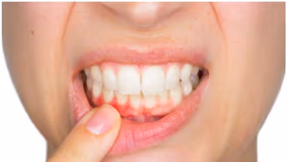 பல் ஈறுகளில் இரத்தம் கசிவா? அப்ப தினமும் காலை 'இத' செய்ங்க..