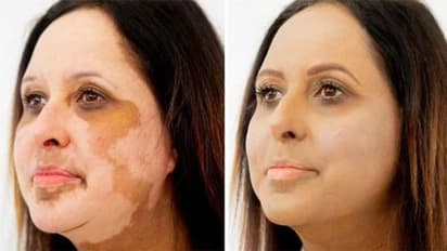 White Spots: மூக்கைச் சுற்றிலும் வெள்ளைப் புள்ளிகள் அசிங்கமா இருக்கா? இதோ சூப்பரான டிப்ஸ்!