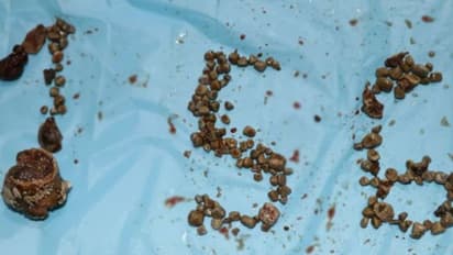 Record Kidney Stones: দেশে এই প্রথম, ল্যাপ্রোস্কোপির মাধ্যমে কিডনি থেকে বেরোল ১৫৬টি স্টোন