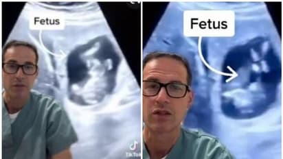 Ectopic Pregnancy : യുവതിയുടെ കരളിനുള്ളില് ഭ്രൂണം വളരുന്നതായി കണ്ടെത്തി; അപൂർവങ്ങളിൽ അപൂർവമെന്ന് ഡോക്ടർമാർ