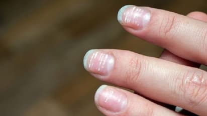 നഖങ്ങളിലെ വരകളും നിറംമാറ്റവും പൊട്ടലും എന്തുകൊണ്ട്? ഈ പരിഹാരം ചെയ്തുനോക്കൂ...