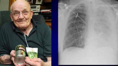 Pea plant in lung : മനുഷ്യന്റെ ശരീരത്തിൽ ചെടി വളരുമോ? 75 -കാരന്റെ ശ്വാസകോശത്തിൽ പയറുചെടി വളര്‍ന്ന കഥ!