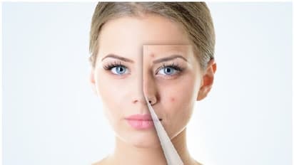 Pimple Marks Cure : മുഖക്കുരുവിന്റെ പാടുകൾ അകറ്റാൻ ഇതാ നാല് സിമ്പിൾ ടിപ്സ്