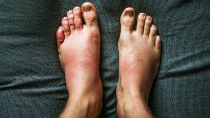 கர்ப்ப காலத்தில் கால் வீக்கத்திற்கு என்ன காரணம்? வீக்கத்தை குறைக்க பெஸ்ட் வழிகள் இதோ..!