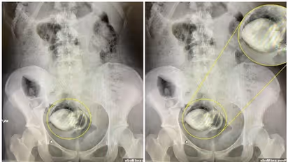 Sex Toy :  യുവതിയുടെ മലദ്വാരത്തിൽ സെക്സ് ടോയ് കുടുങ്ങി; പിന്നീട് സംഭവിച്ചത്...
